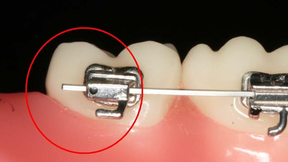 Arc qui pique en distal au fond de la bouche