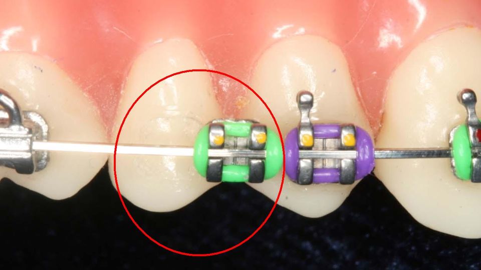 attache décollée - traitement orthodontique - Orthodontiste Thonon Les Bains