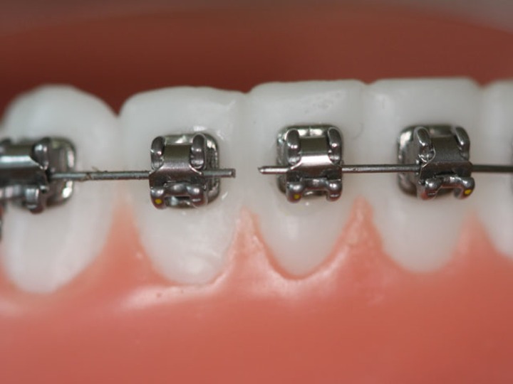 arc cassé - traitement orthodontique - Orthodontiste Thonon Les Bains