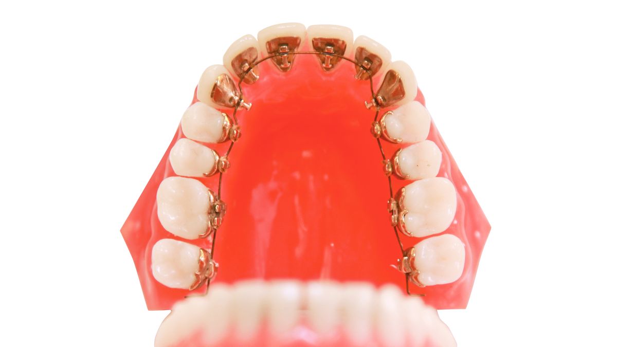 Appareil dentier - traitement orthodontique - Orthodontiste Thonon Les Bains