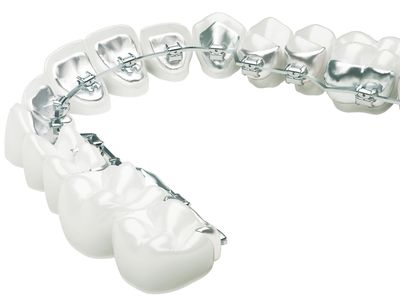 traitement orthodontique - Orthodontiste Thonon Les Bains