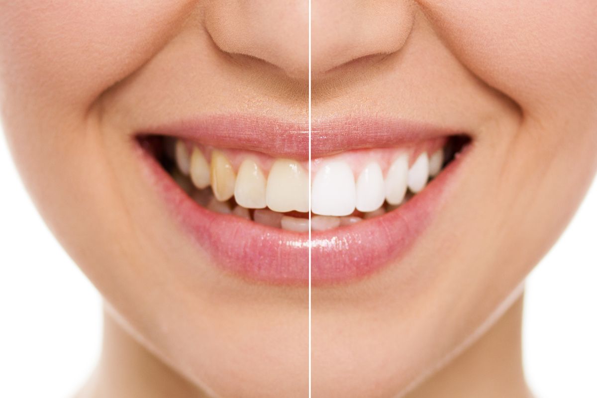 traitement orthodontique - Orthodontiste Thonon Les Bains