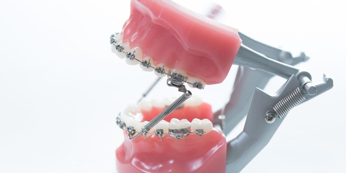 Propulseur mandibulaire fixe - traitement orthodontique - Orthodontiste Thonon Les Bains