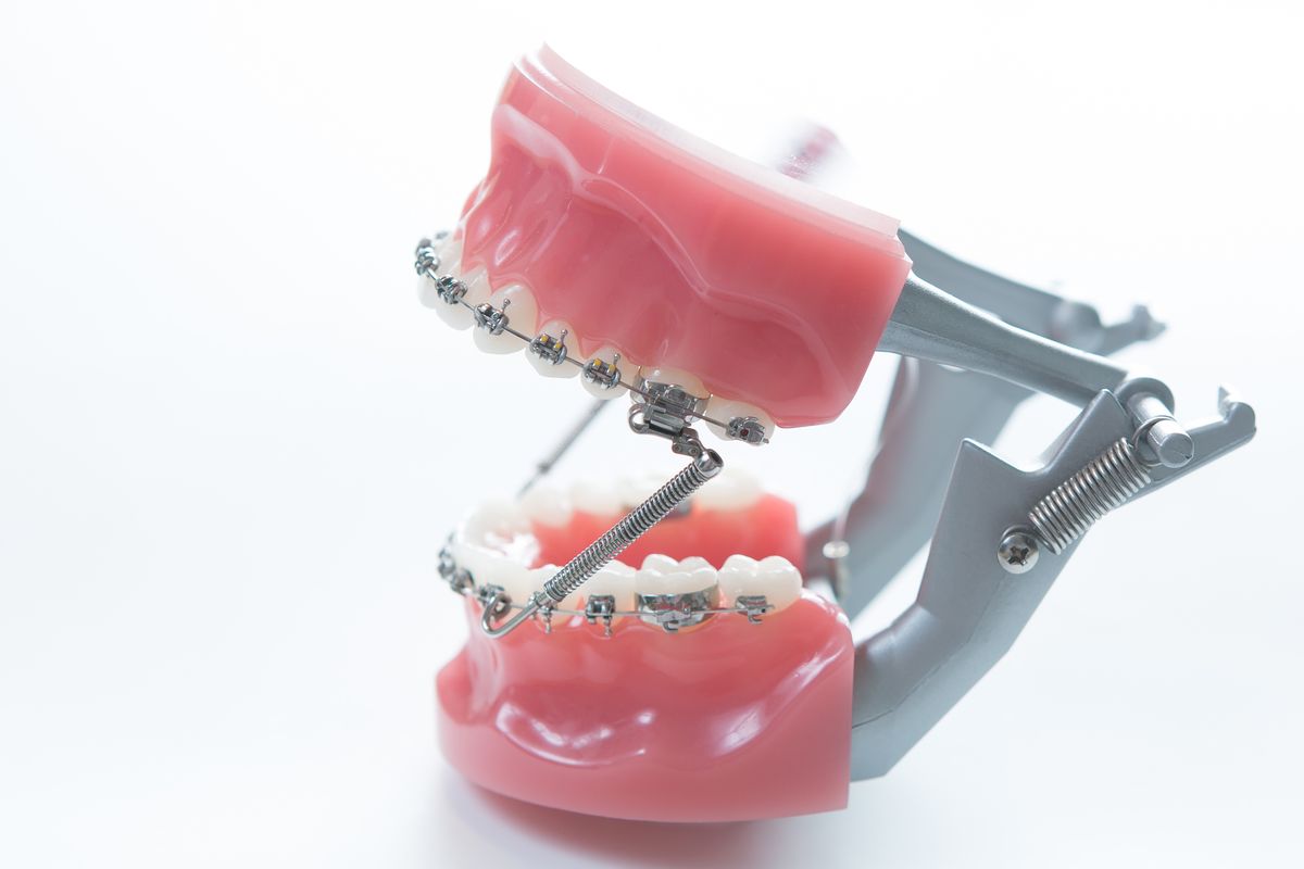Propulseur mandibulaire fixe - traitement orthodontique - Orthodontiste Thonon Les Bains